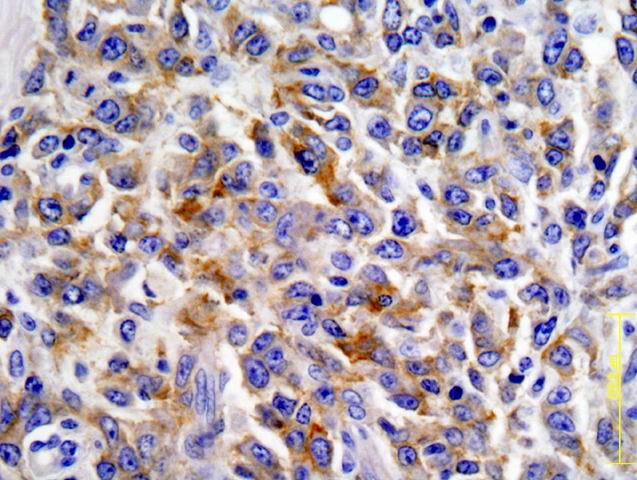 Fig.2: DLBCL. CD20 - <div style=